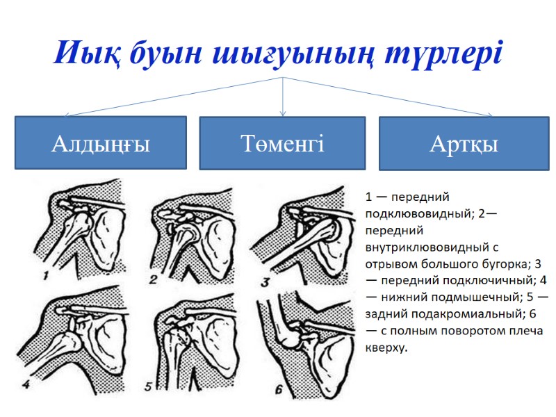 Иық буын шығуының түрлері Алдыңғы Артқы Төменгі 1 — передний пoдклювовидный; 2— передний внутриклювовидный